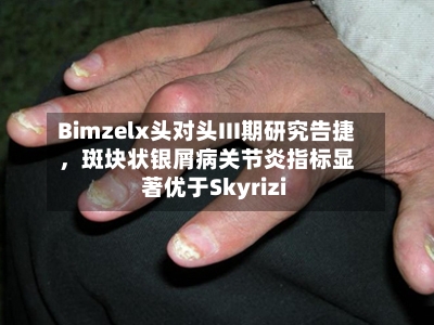 Bimzelx头对头III期研究告捷，斑块状银屑病关节炎指标显著优于Skyrizi-第2张图片