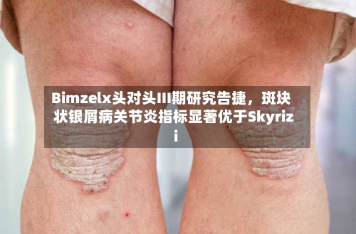 Bimzelx头对头III期研究告捷，斑块状银屑病关节炎指标显著优于Skyrizi-第3张图片